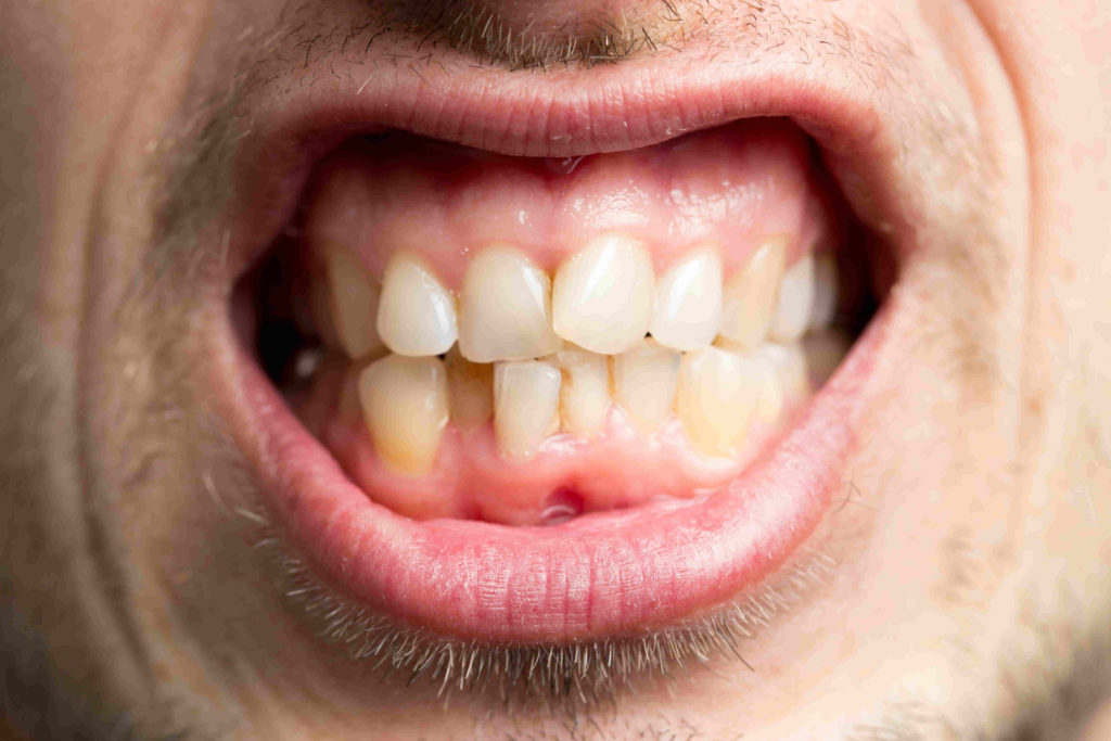 Le mauvais alignement des dents chez l’adulte